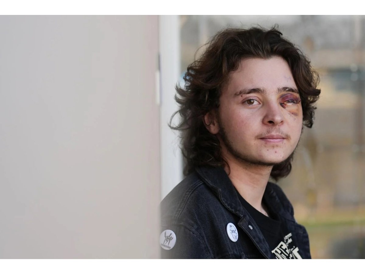 Joven pierde un ojo durante protesta contra ICE en California: relato y controversia