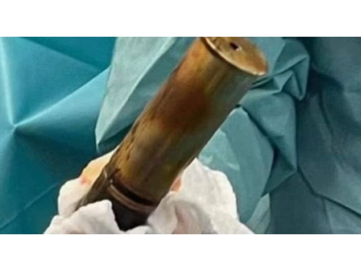 Extraen obús de la Primera Guerra Mundial del recto de un joven en hospital francés