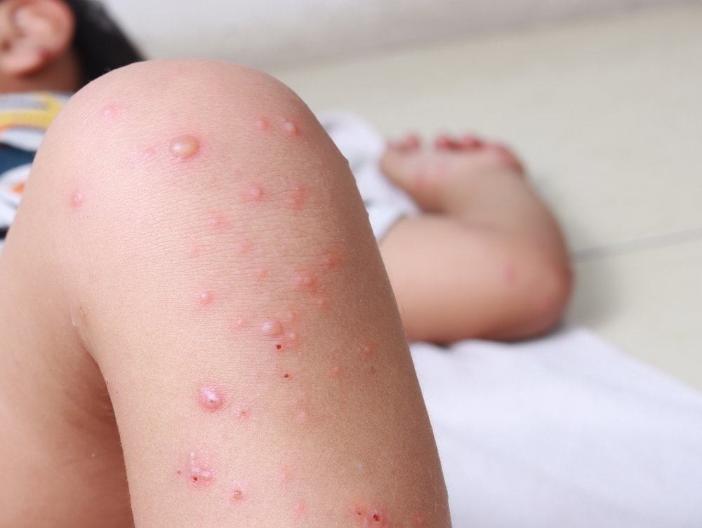 Sarampión en Guatemala: Sololá como epicentro y factores del rápido avance del brote