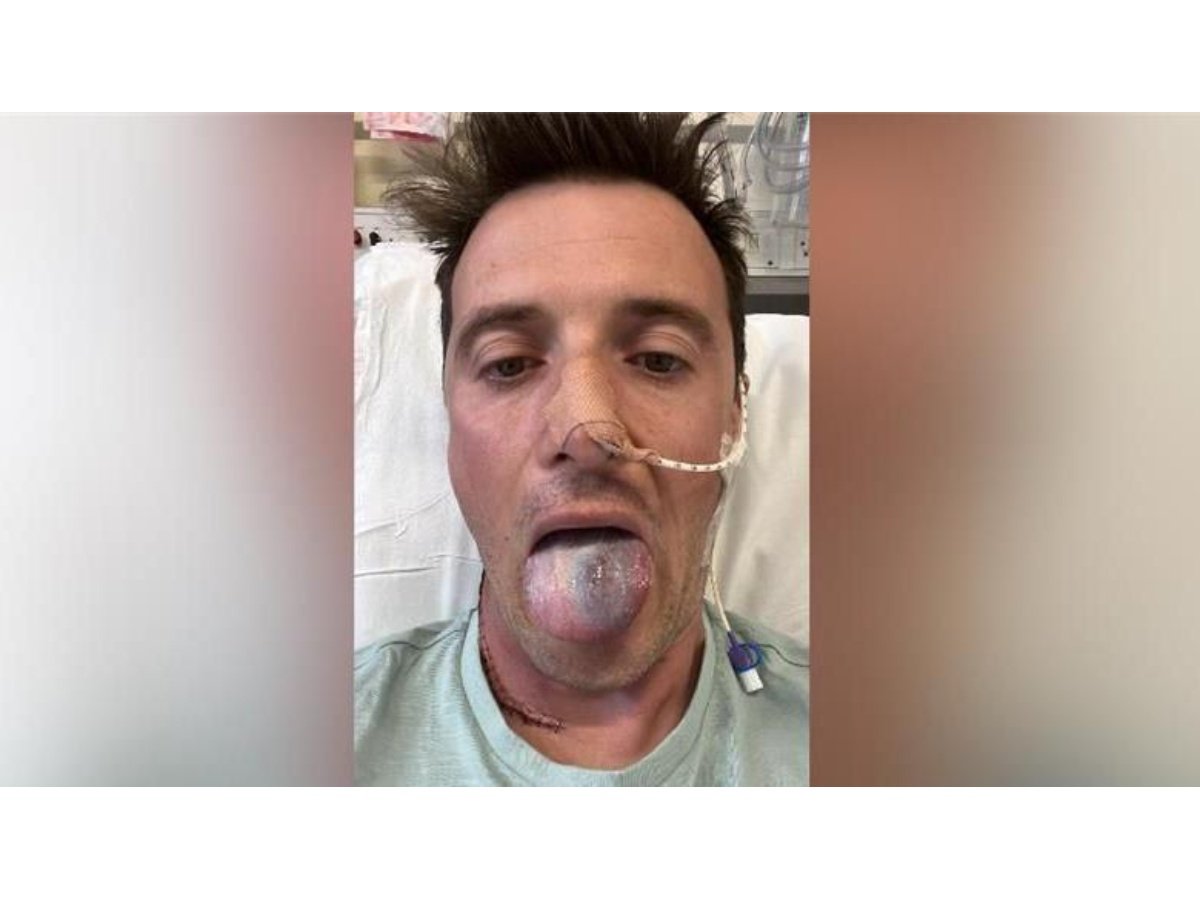 Alerta sobre el virus del papiloma humano: caso de cáncer de lengua en hombre que casi pierde la vida