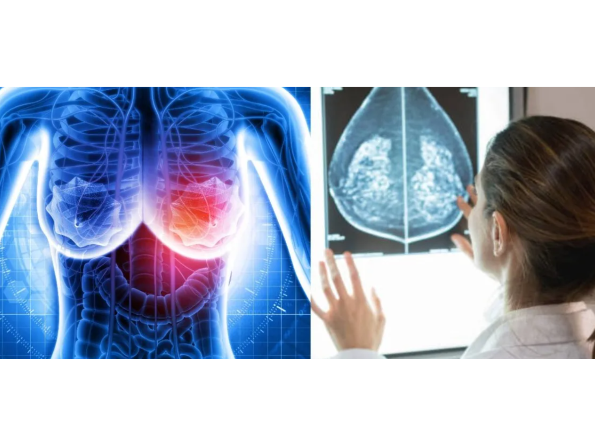 Sindicato médico denuncia desabastecimiento de anastrozol para cáncer de mama en ISSS Sindicato médico denuncia desabastecimiento de anastrozol para cáncer de mama en ISSS