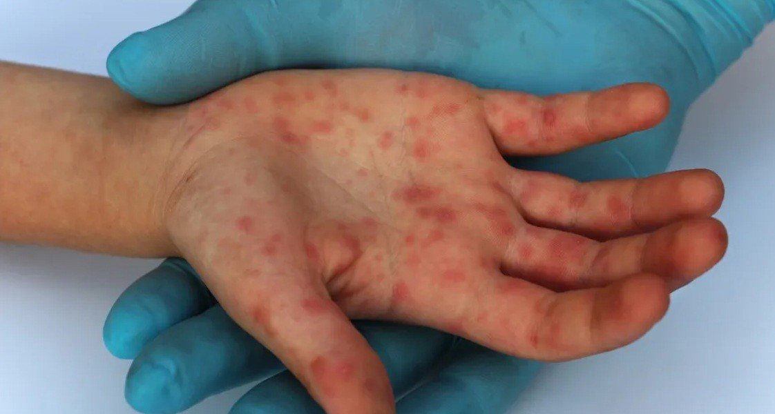 Casos de sarampión se duplican en Guatemala y el virus ya afecta al 95% del territorio nacional