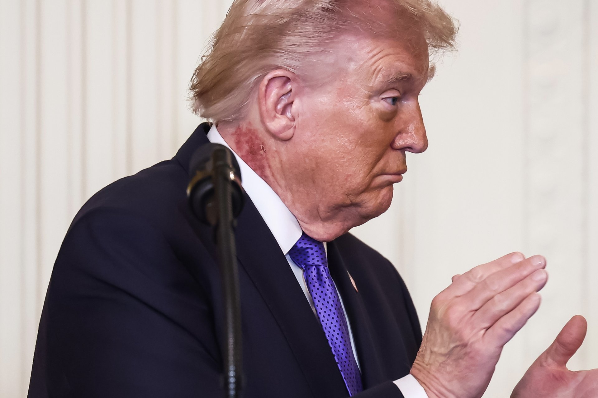 Explicación médica sobre el sarpullido en el cuello de Donald Trump durante acto oficial