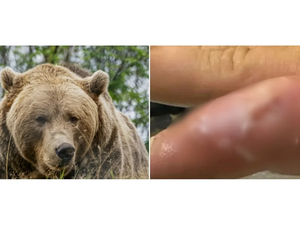 Primer caso mundial de infección ‘dedo de foca’ tras contacto con oso pardo en Alaska