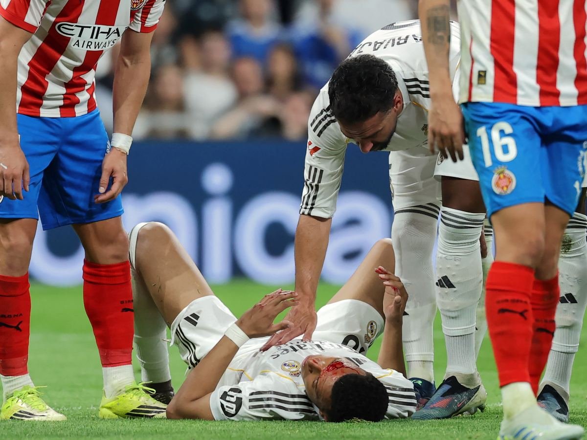 Mbappé se ausenta en entrenamiento del Real Madrid por precaución tras lesión en ceja
